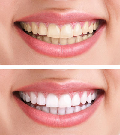 Teeth whitening from Sheffield dentist